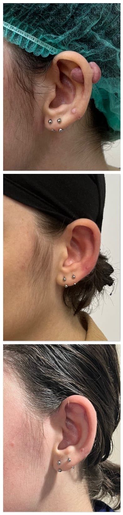 Ear keloid, clinical photograph 1