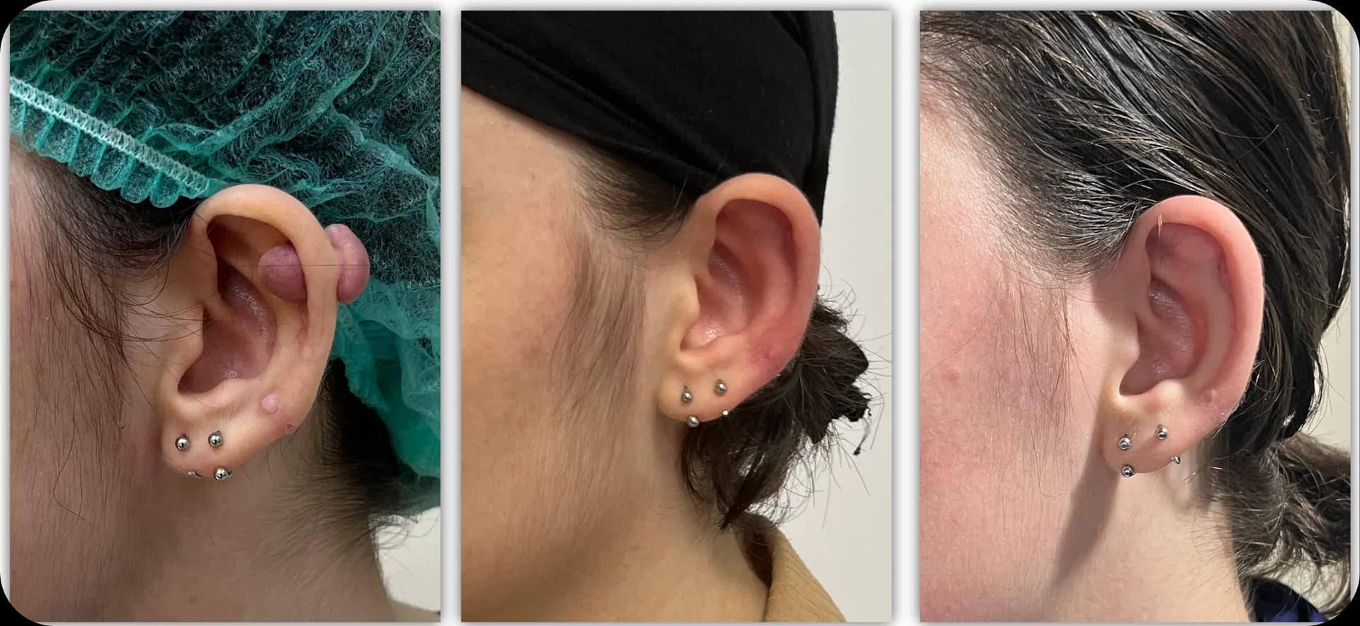 Ear keloid, clinical photograph 1