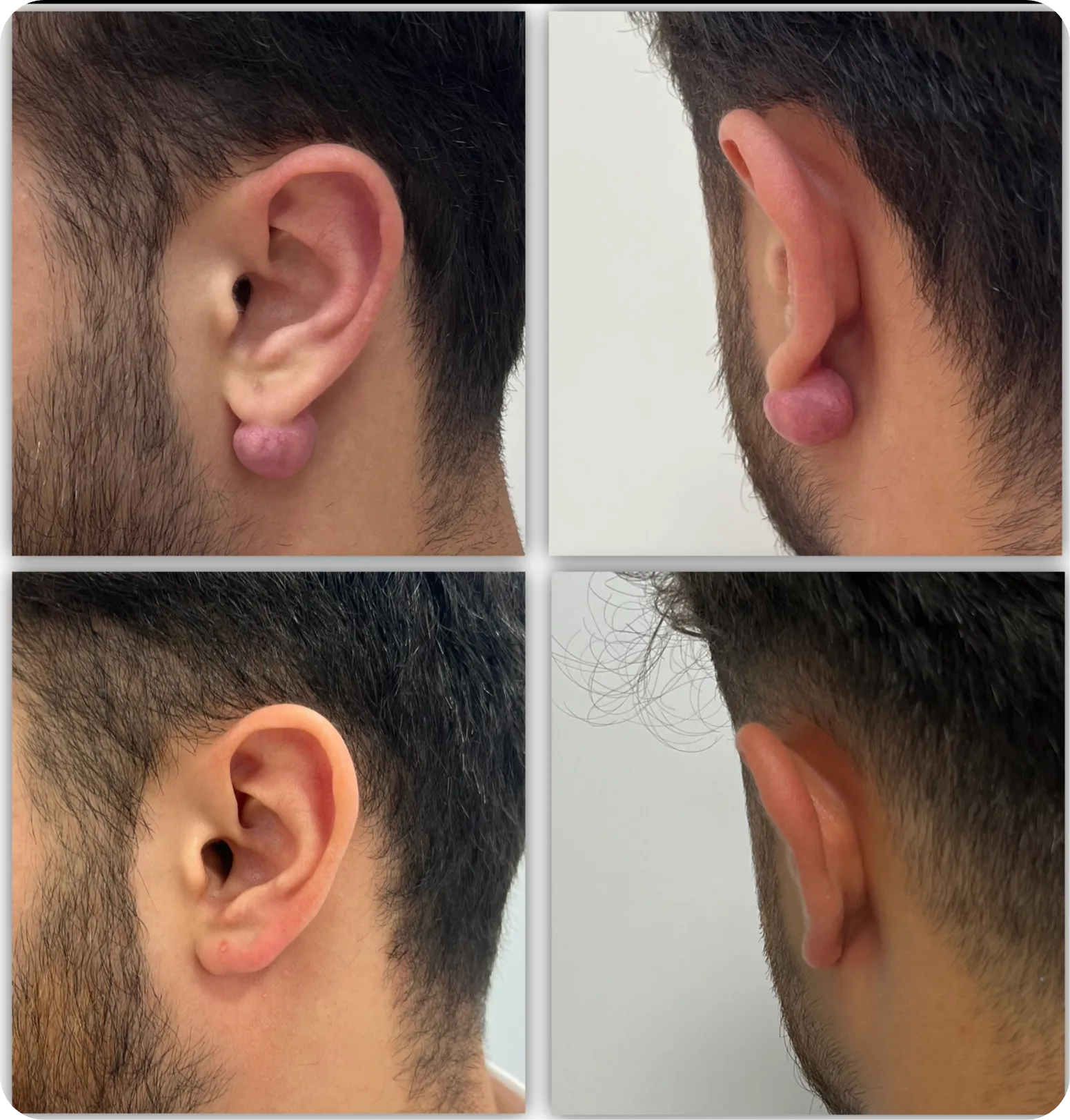 Ear keloid, clinical photograph 2