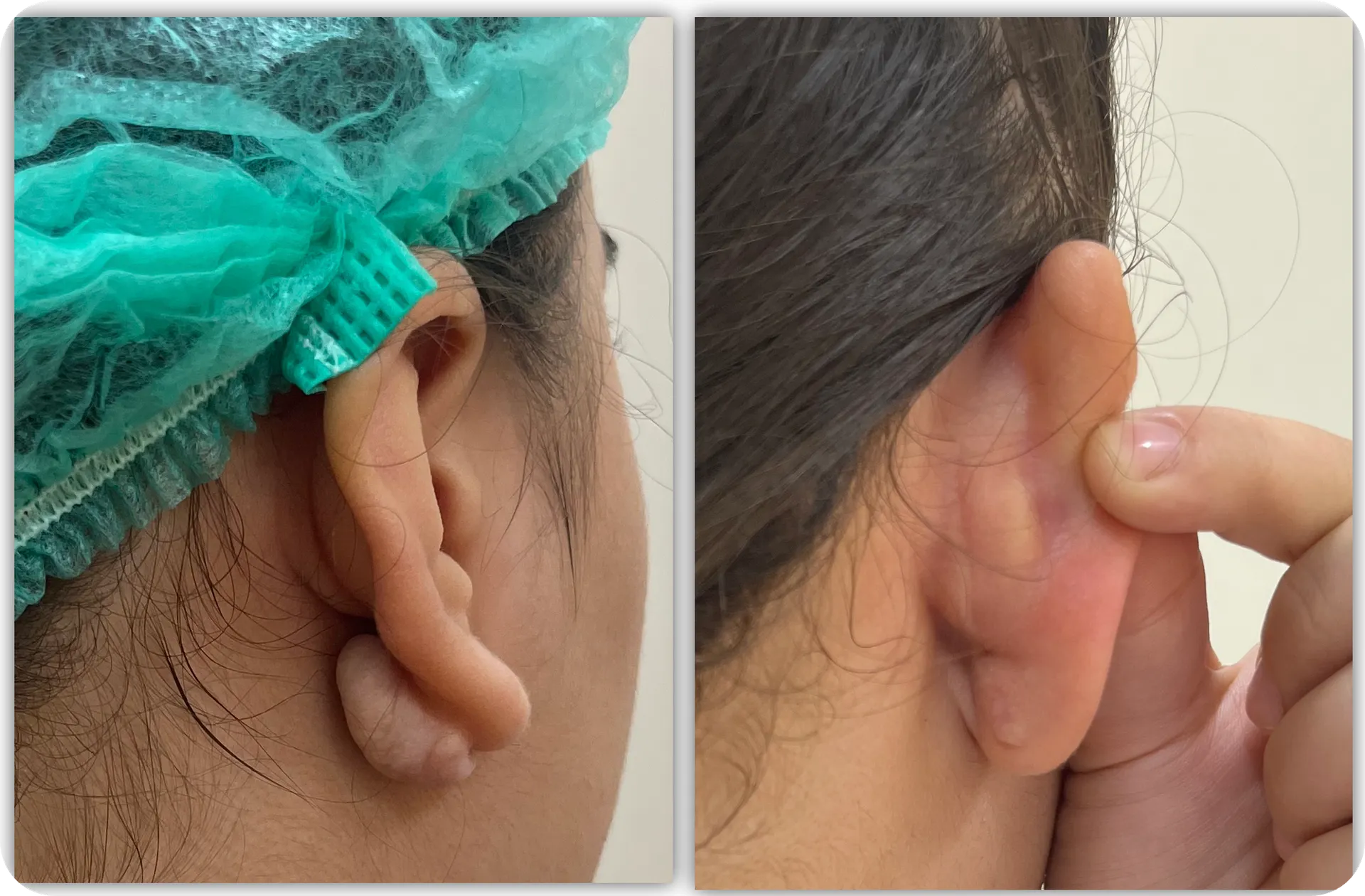 Ear keloid, clinical photograph 3