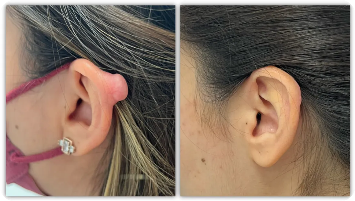 Ear keloid, clinical photograph 4