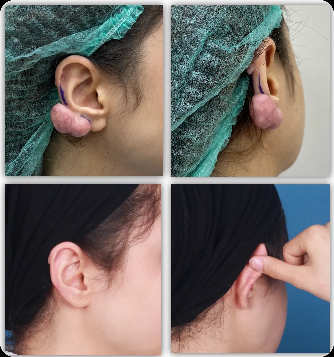 Ear keloid, clinical photograph 5