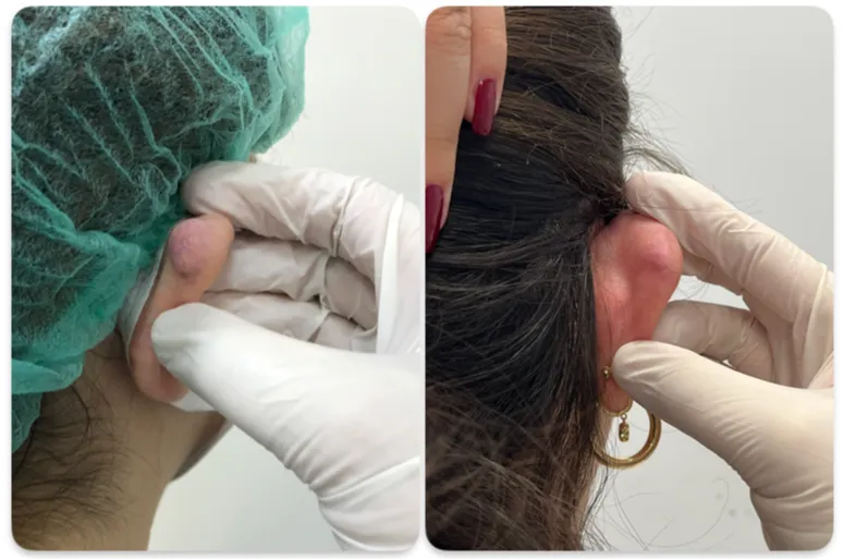Ear keloid, clinical photograph 6